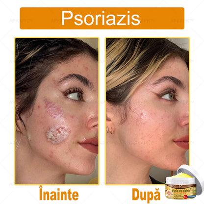 APKAPK™ Cremă Complexă cu Venin de Albine 🌿 Aprobată și Recomandată de AAD