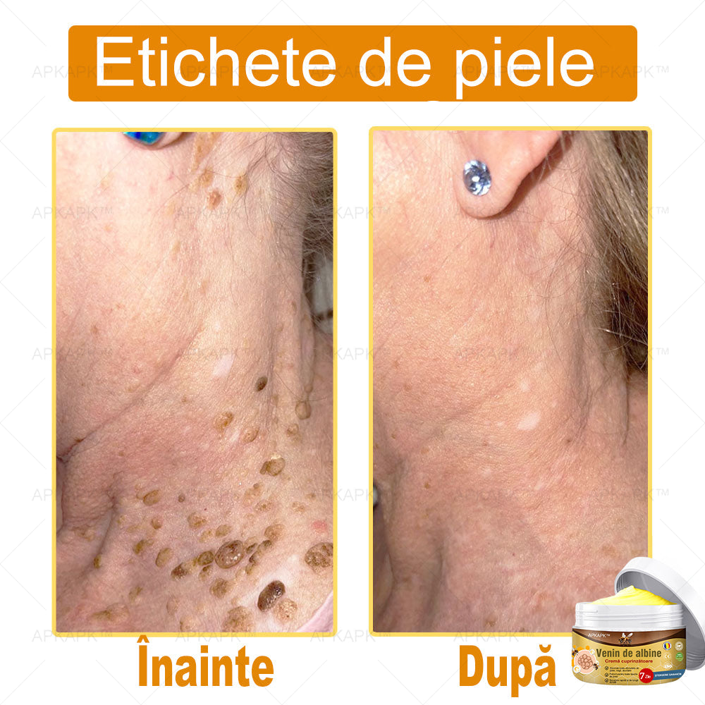 APKAPK™ Cremă Complexă cu Venin de Albine 🌿 Aprobată și Recomandată de AAD