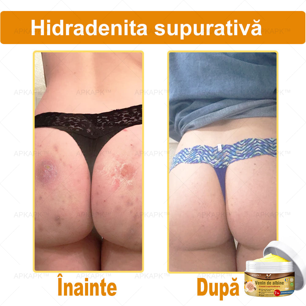 APKAPK™ Cremă Complexă cu Venin de Albine 🌿 Aprobată și Recomandată de AAD